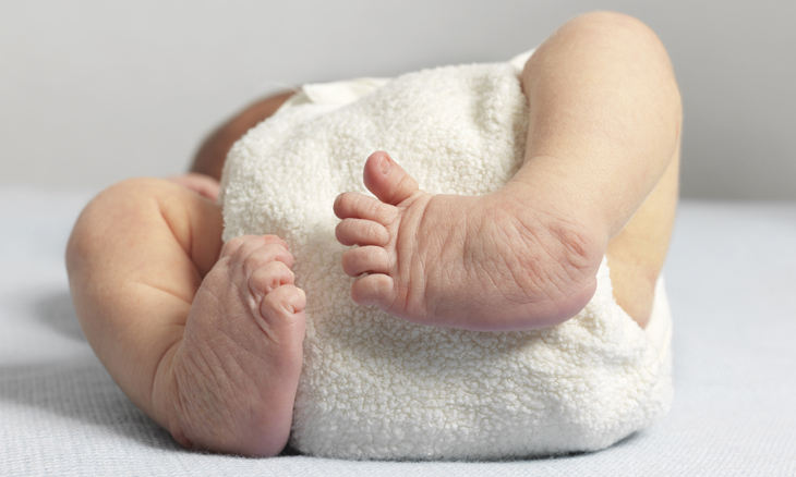 Clubfoot treatment in hyderabad
